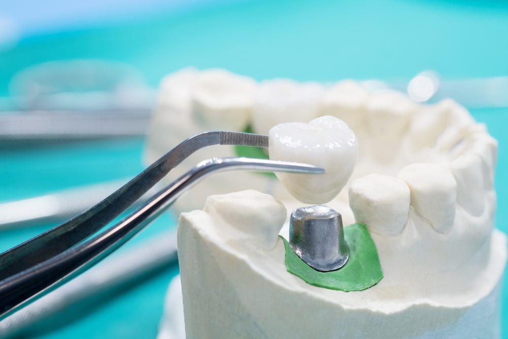 歯科治療　補綴物